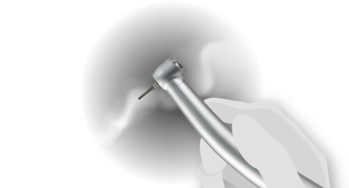 handpieces types: The Air-Driven Dental Handpiece